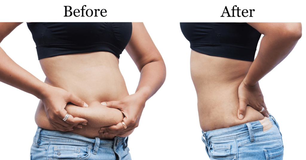 Unveiling the Best Weight Loss Program: Advanced Bariatric Clinic in Hyderabad